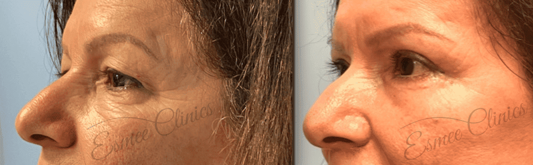 Before and After img